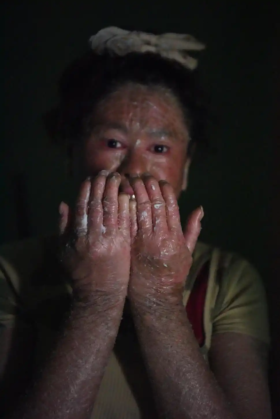 CON CUIDADO. Para no lastimarse la piel, Eliana debe tener muchas precauciones. Si sale, debe usar guantes.  LA GACETA / FOTO DE ANALIA JARAMILLO