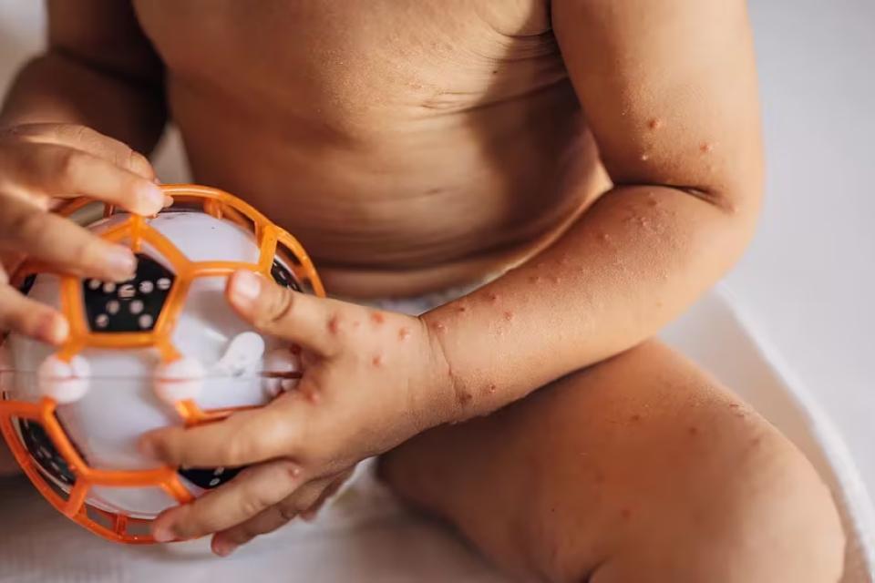 Salta: confirmaron un caso de sarampión en un bebé de 19 meses