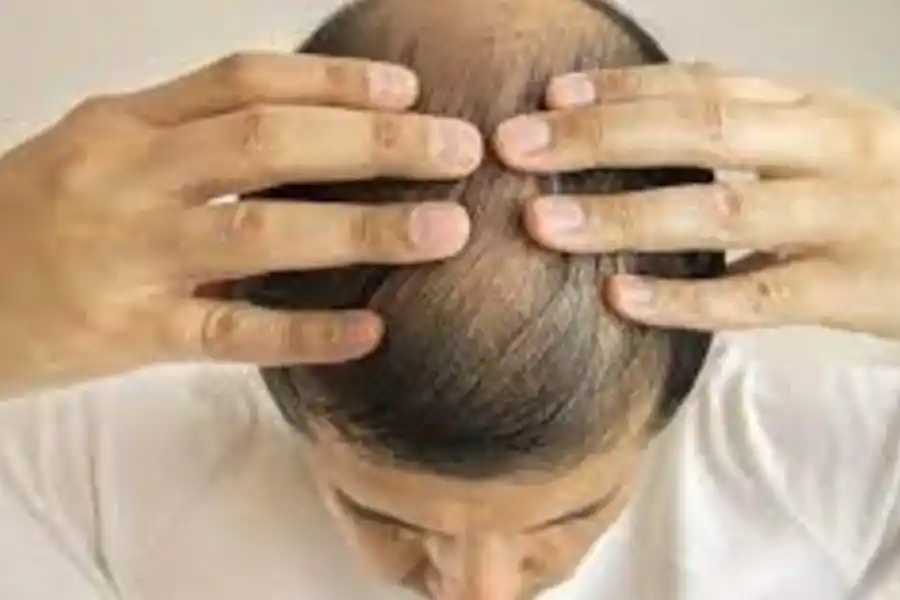 Alopecia: qué vitaminas hay que consumir para evitar la caída del cabello