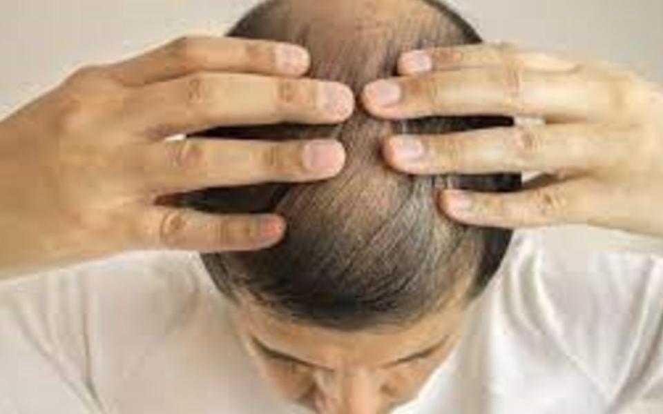 Alopecia: qué vitaminas hay que consumir para evitar la caída del cabello