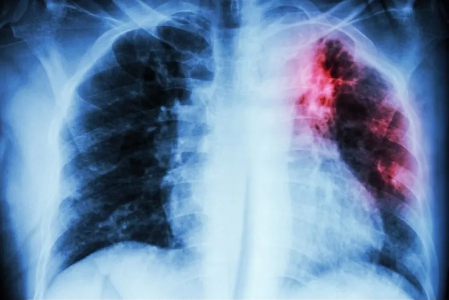 ¿De qué se trata el tratamiento contra el cáncer de pulmón aprobado por Anmat?