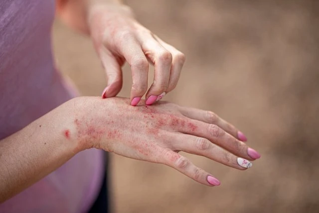 SÍNTOMAS. La dermatitis atópica se manifiesta en la piel con prurito, enrojecimiento y engrosamiento.