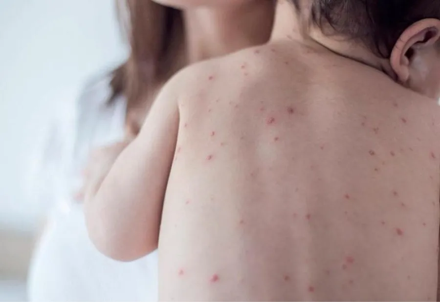 Confirman un nuevo caso de sarampión en un bebé de 13 meses que llegó desde España