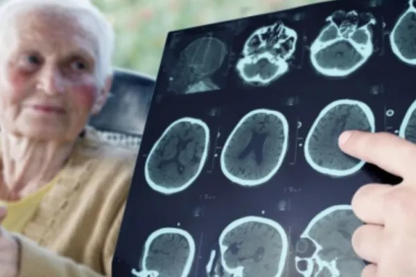 Revelan el origen de los primeros casos de transmisión del Alzheimer: un tratamiento con hormonas de crecimiento