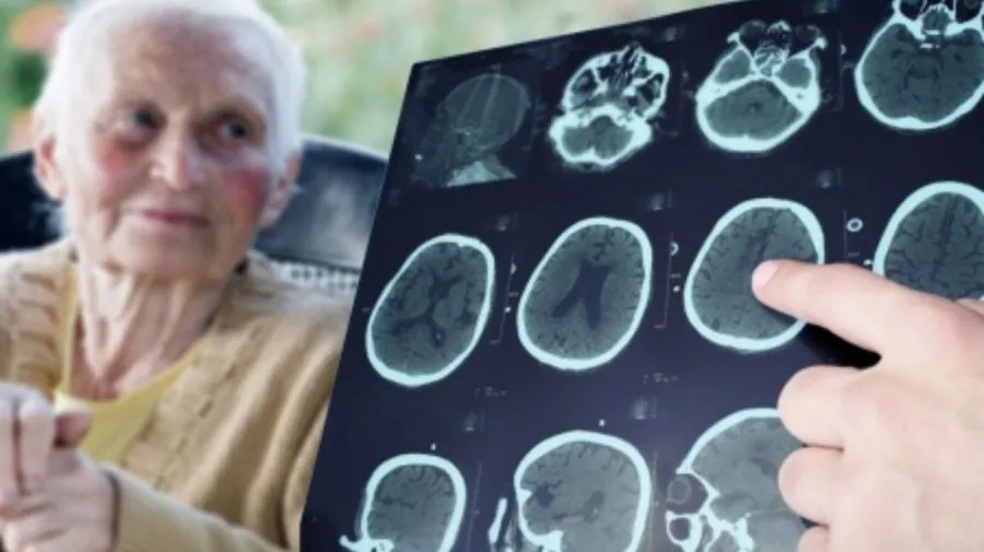 Revelan el origen de los primeros casos de transmisión del Alzheimer: un tratamiento con hormonas de crecimiento
