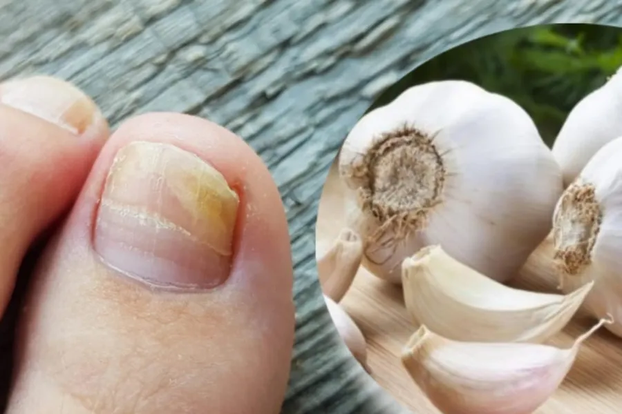 Muchas personas utilizan un diente de ajo para tratar los hongos de los pies
