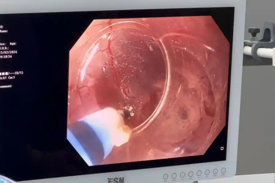 EL PROCEDIMIENTO. Imagen en la pantalla de un momento de la operación.