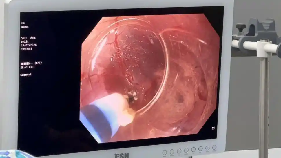 EL PROCEDIMIENTO. Imagen en la pantalla de un momento de la operación.