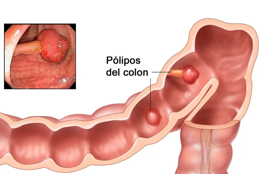 Cáncer de colon: consejos a tomar en cuenta y con un simple test a tiempo se puede curar