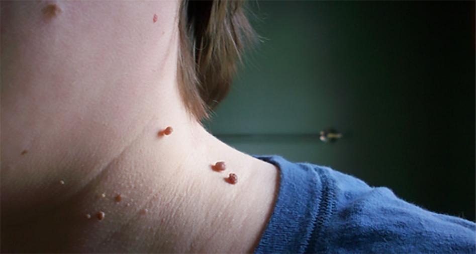 Verrugas en el cuello: por qué aparecen y cómo podemos tratarlas