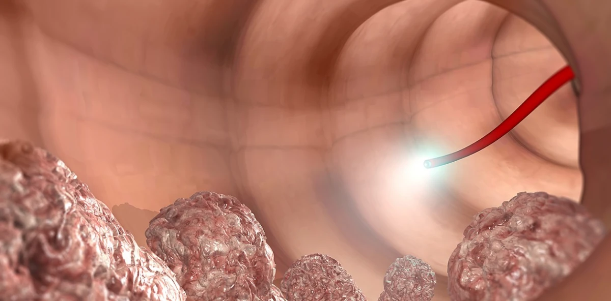 Una colonoscopia es clave para detectar el cáncer de colon de manera temprana.