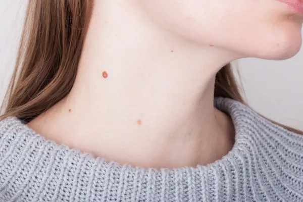 Verrugas en el cuello: cómo eliminarlas con alternativas caseras y no recurrir a cirugía