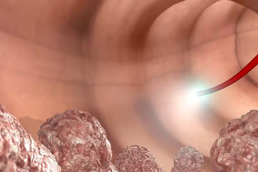 Una colonoscopia es clave para detectar el cáncer de colon de manera temprana.