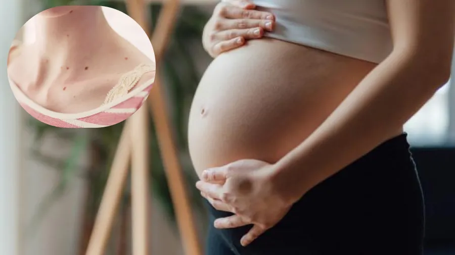 Verrugas en el cuello durante el embarazo: ¿por qué se producen y qué posibilidades hay de contagiar a los bebés?