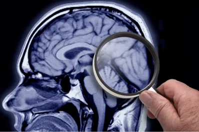 ¿Cómo empieza el Alzheimer? Estos son sus tres primeros síntomas