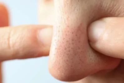 El truco casero para eliminar los puntos negros de tu piel