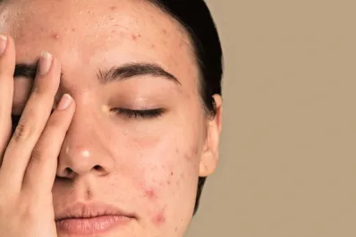 Acné por estrés: por qué aparece y qué hacer para eliminarlo