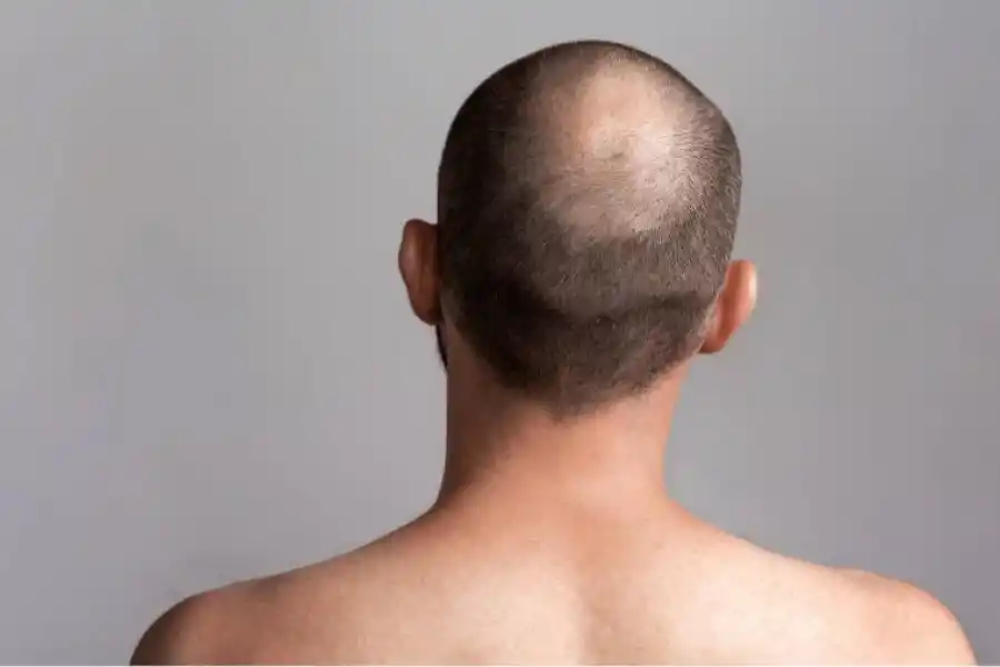 Caída del pelo: cuáles son los efectos secundarios más comunes de un trasplante capilar