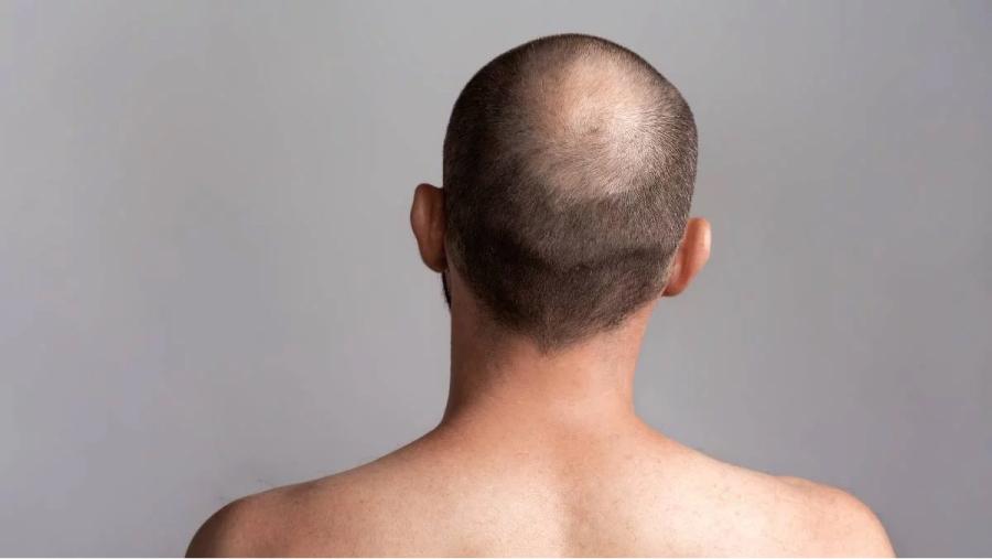 Caída del pelo: cuáles son los efectos secundarios más comunes de un trasplante capilar