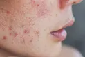 El 59% de los adolescentes con acné confía más en influencers que en dermatólogos, según un estudio