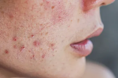 Los 7 mitos falsos sobre el acné que deberíamos saber y erradicar ahora