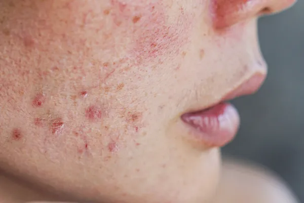El 59% de los adolescentes con acné confía más en influencers que en dermatólogos, según un estudio