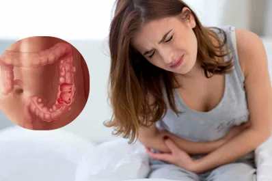 Qué es la diverticulosis y por qué puede aparecer después de los 40