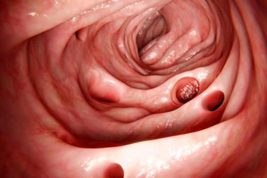 La diverticulosis consiste en la formación de unas pequeñas bolsas en el intestino grueso, que reciben el nombre de divertículos
