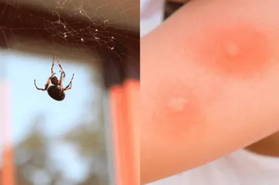Picaduras de araña: cuáles son los riesgos, cómo identificar las más peligrosas y qué hacer ante ellas