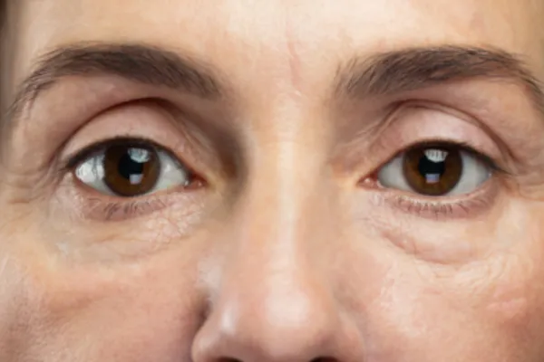 Ojeras: por qué aparecen, qué tipos existen y la receta casera para atenuarlas