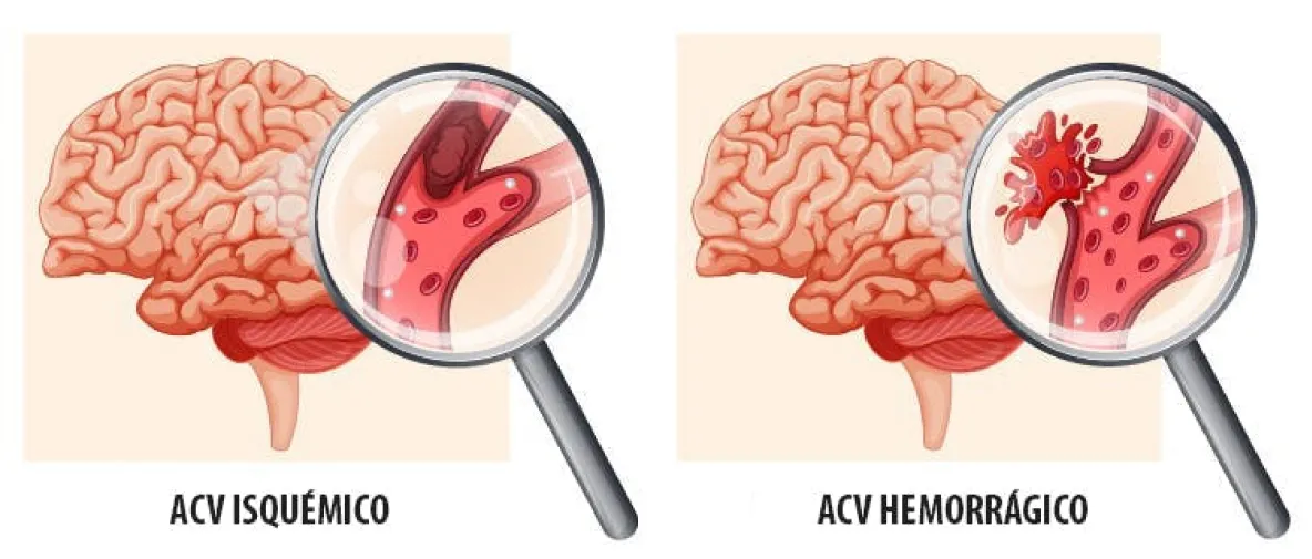 Cuáles son las cinco señales que advierten un posible derrame cerebral