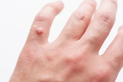 Cómo quitar verrugas fácilmente desde casa: guía paso a paso