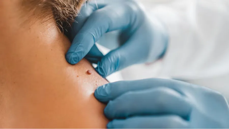 Cáncer de piel: la exposición a los rayos UV  del sol es su principal causa