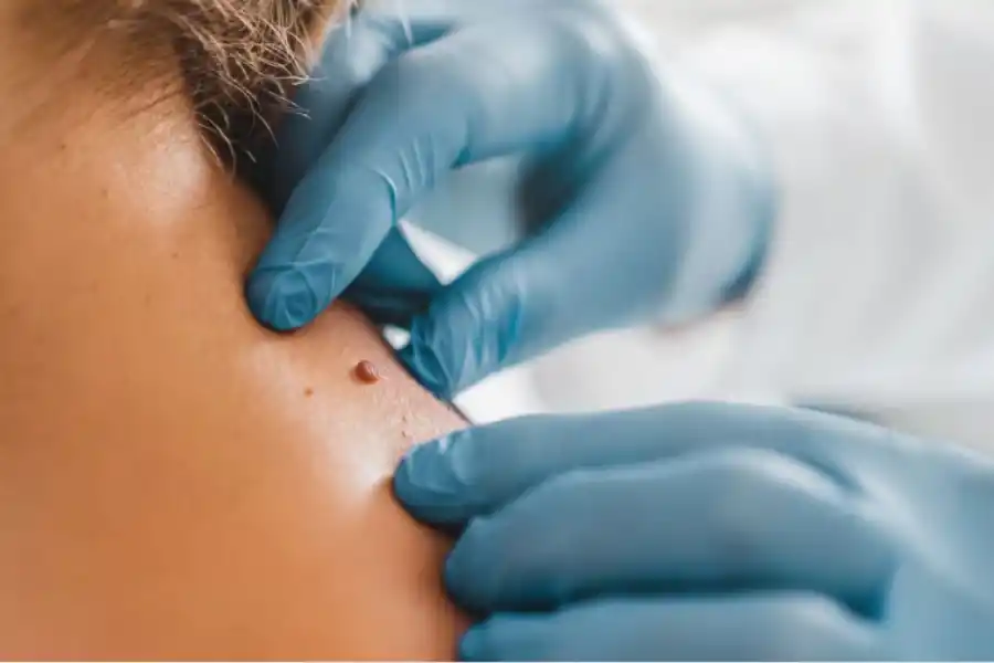 Cáncer de piel: la exposición a los rayos UV  del sol es su principal causa