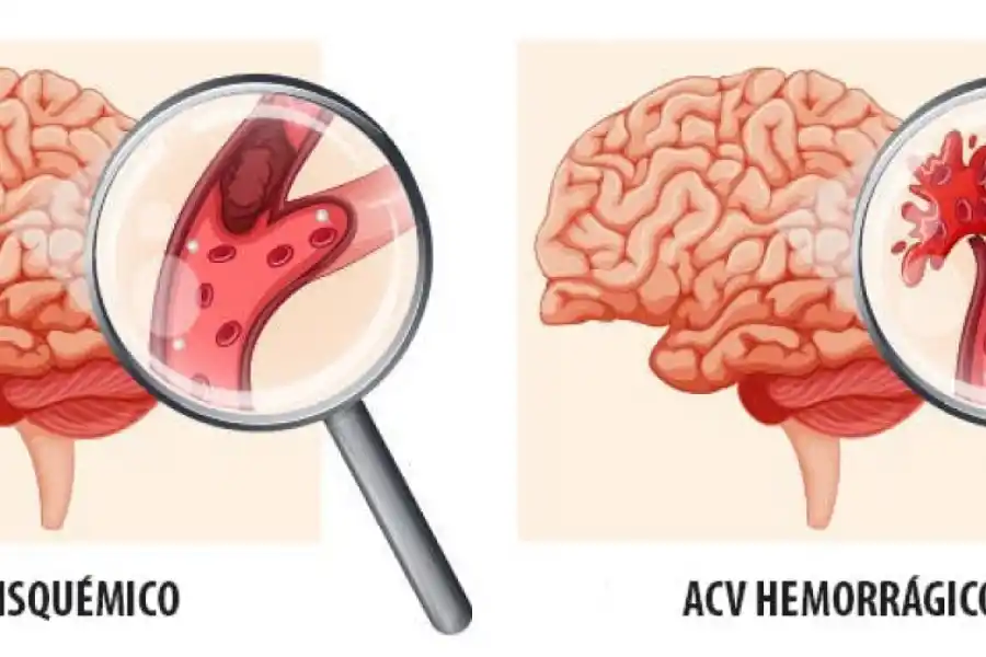 Cómo reconocer un derrame cerebral: las cinco señales más comunes