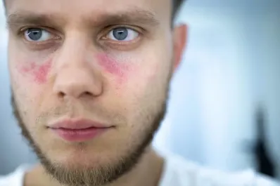 Lupus, la enfermedad de las alas de mariposa: cómo detectarla y cuáles son sus complicaciones