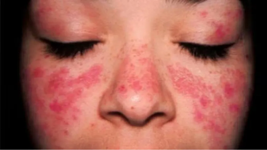 Uno de los signos de padecer lupus es la aparición de la conocida 