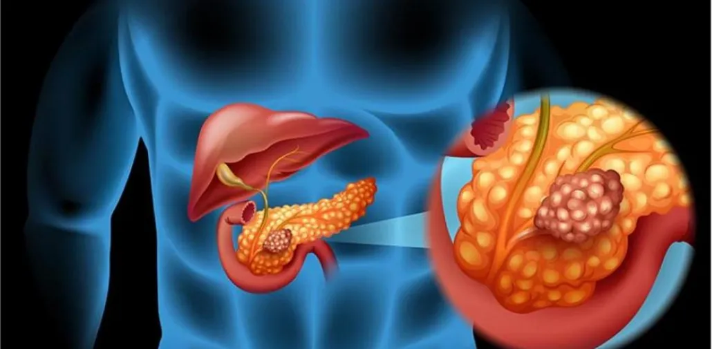 El cáncer de páncreas es uno de los más agresivos.
