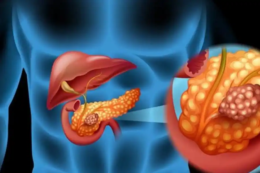 El cáncer de páncreas es uno de los más agresivos.