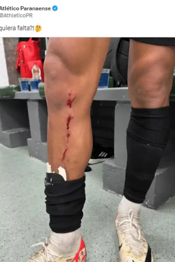 Un ex Atlético Tucumán sufrió un salvaje planchazo en Brasil