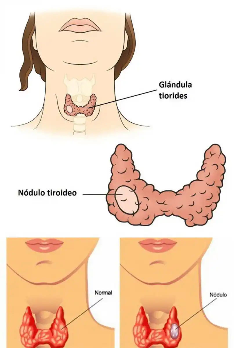 Bultos en el cuello: cómo identificar si podrían ser cáncer de tiroides
