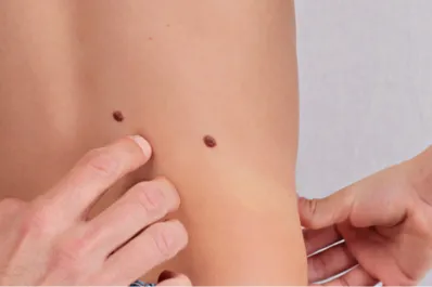 Cómo detectar a tiempo un lunar maligno y qué enfermedades puede ocasionar