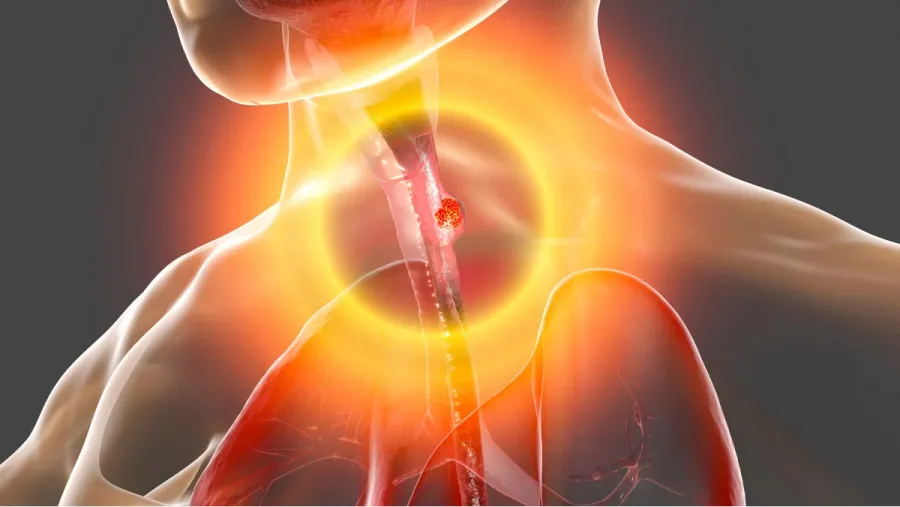 Tumor de esófago: los principales síntomas son dificultad para tragar y dolor de pecho