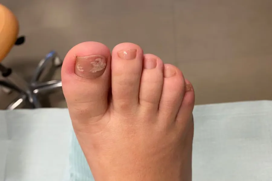 Las uñas frágiles y quebradizas son un síntoma de psoriasis