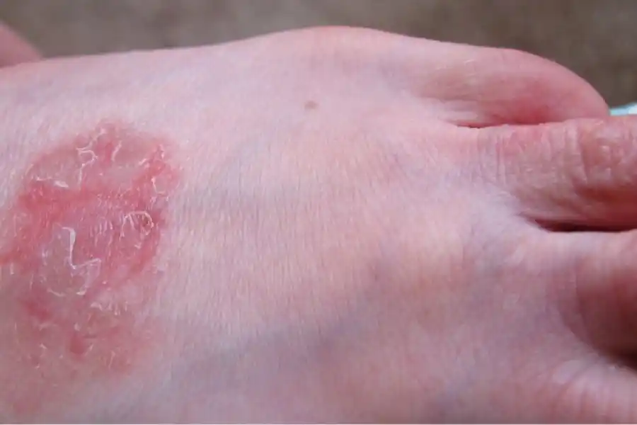 Roncha roja o rosada en el empeine puede indicar una psoriasis.