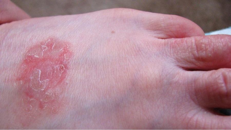 Roncha roja o rosada en el empeine puede indicar una psoriasis.