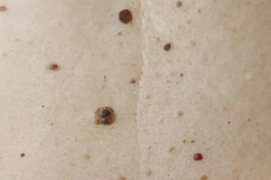 Por qué nos aparecen pequeñas verrugas con la edad y cuándo ir al médico