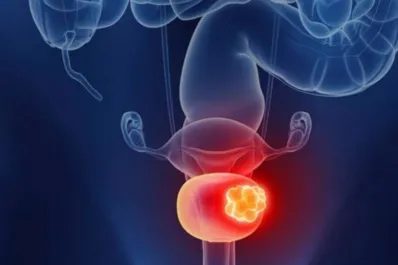 Cáncer de vejiga: cuáles son los síntomas y cuándo consultar urgente al médico