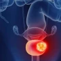 Cáncer de vejiga: cuáles son los síntomas de alerta y cuándo consultar al médico