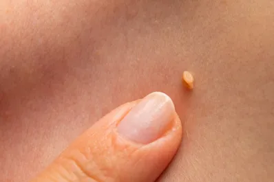 ¿Cuándo preocuparse por una verruga? Señales de alerta que no debes ignorar